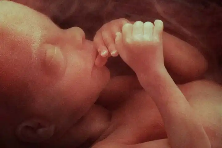 کیستیک هیگروما چیست؟ آیا باعث سقط جنین می شود؟